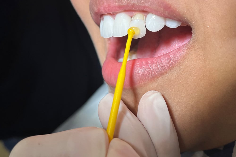 Laminate Veneers & Lumineers Creative Smiles Turkey